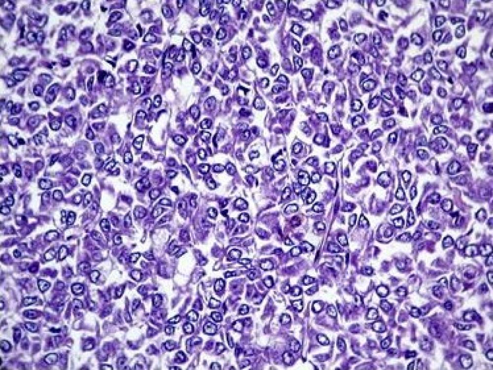 Partes Moles, Lipossarcoma de células redondas (Mixóide)