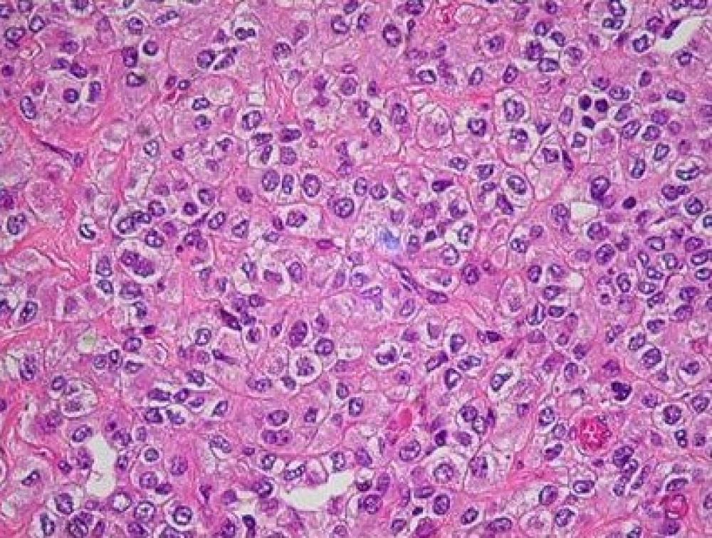 Pulmão, Angioma Esclerosante (Pneumocitoma)