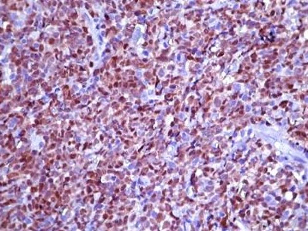 Estômago, Carcinoma Fusocelular (Sarcomatóide)