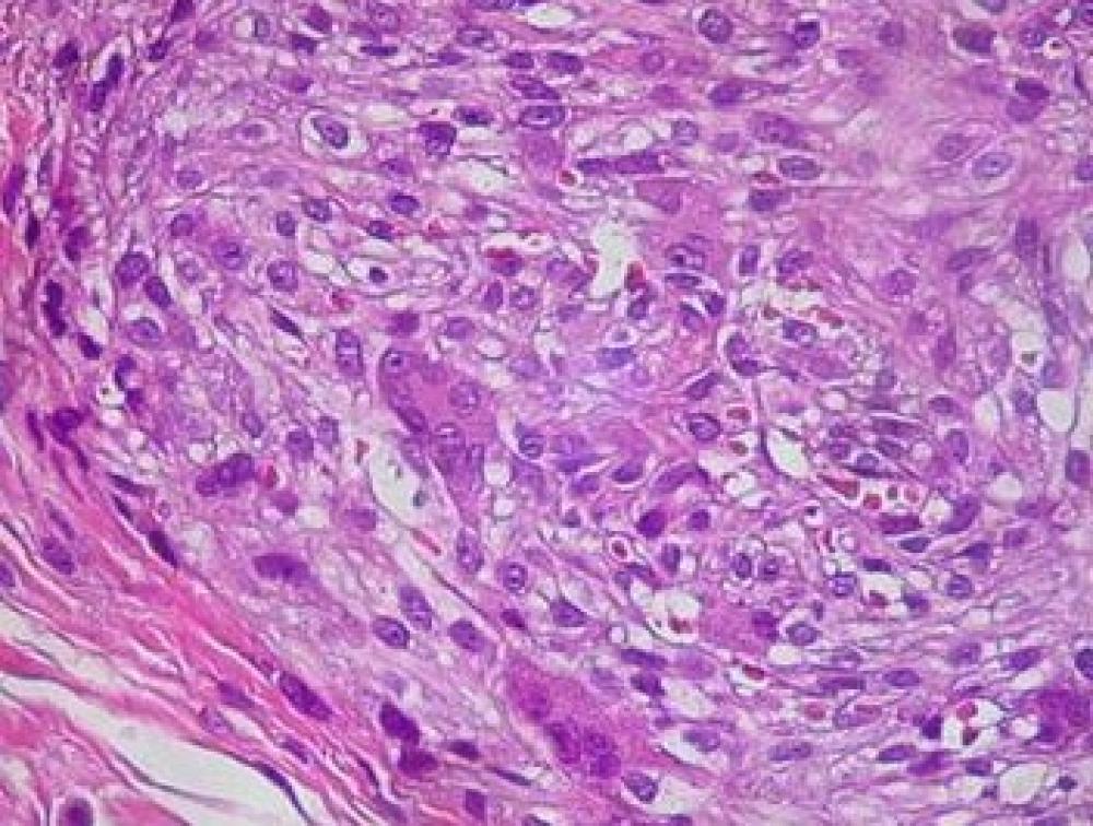 Partes Moles, Fibrohistiocitoma Plexiforme